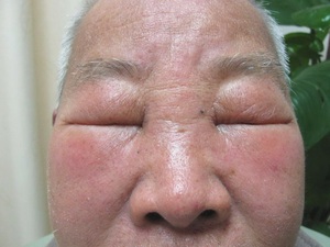 颜面水肿