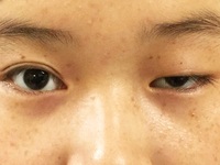 眼睑下垂