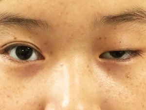 眼睑下垂