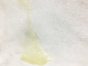 精液发黄