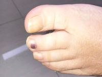 甲下出血