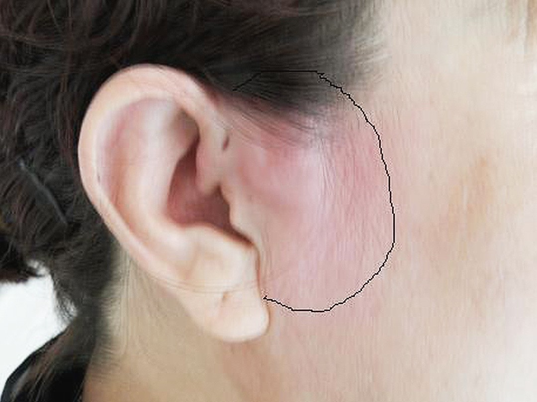 耳朵前面的淋巴位置图图片