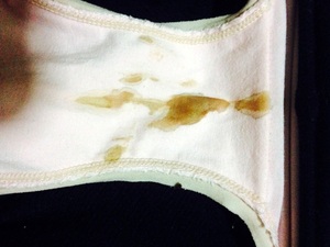 阴道分泌物增多