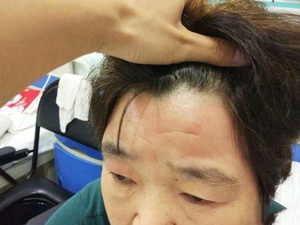 额部疼痛