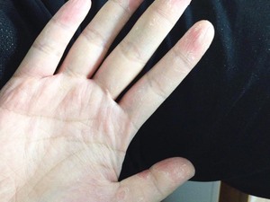 手部脱皮