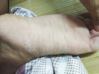手足脱皮