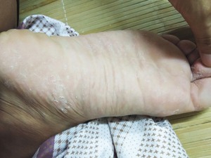 手足脱皮