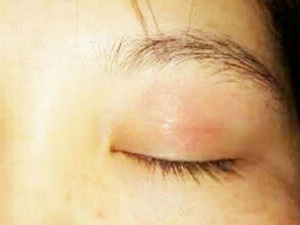 眼睑瘙痒
