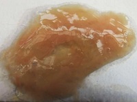 铁锈色痰