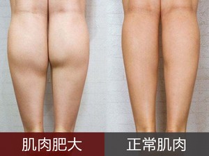 肌肉肥大