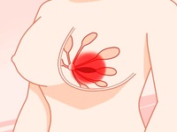 乳房红肿热痛
