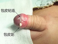 包皮粘连