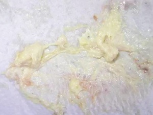 无胆汁粪便