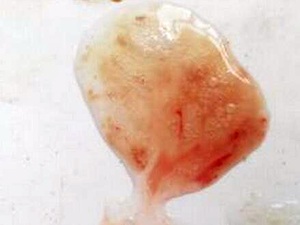 痰中带血丝