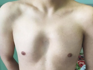 胸壁塌陷