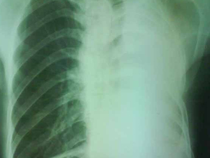渗出性胸腔积液