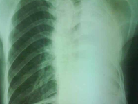 渗出性胸腔积液