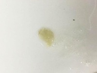 脓痰