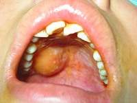 唾液腺肿大