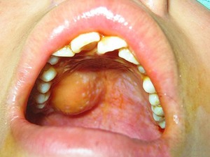 唾液腺肿大