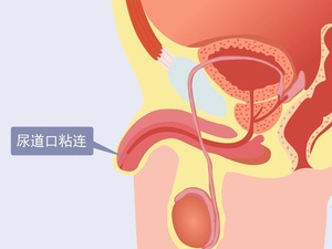 尿道口粘连