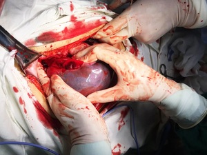 腹腔出血