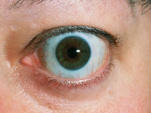 突眼症