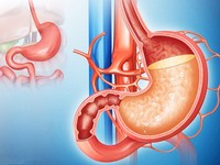 胃源性腹泻