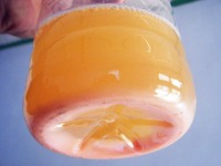 尿液混浊