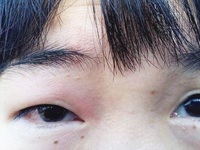 睁眼困难