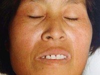 肝病面容