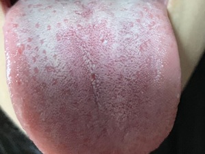 味觉障碍