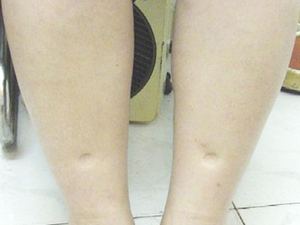 双下肢凹陷性水肿