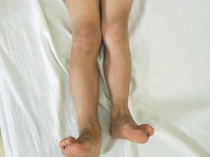 下肢缩短