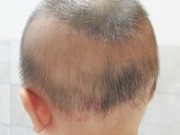 缺钙