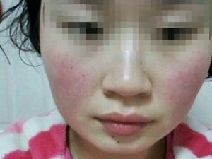面红