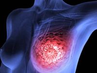 乳腺结节