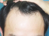 发际线后移