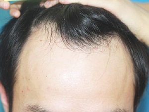 发际线后移