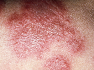 糖尿病皮肤病变