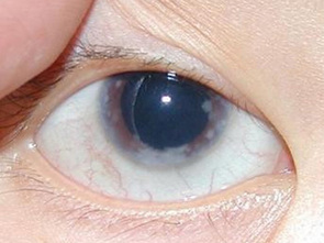 房角后退性青光眼