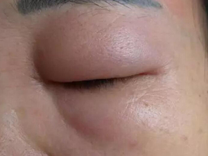 血管性水肿