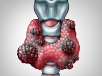 甲状腺瘤