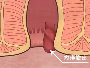 内痔