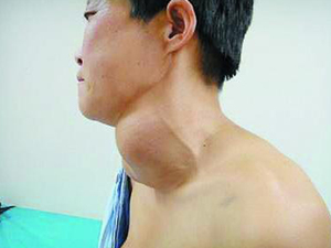 慢性淋巴细胞性甲状腺炎