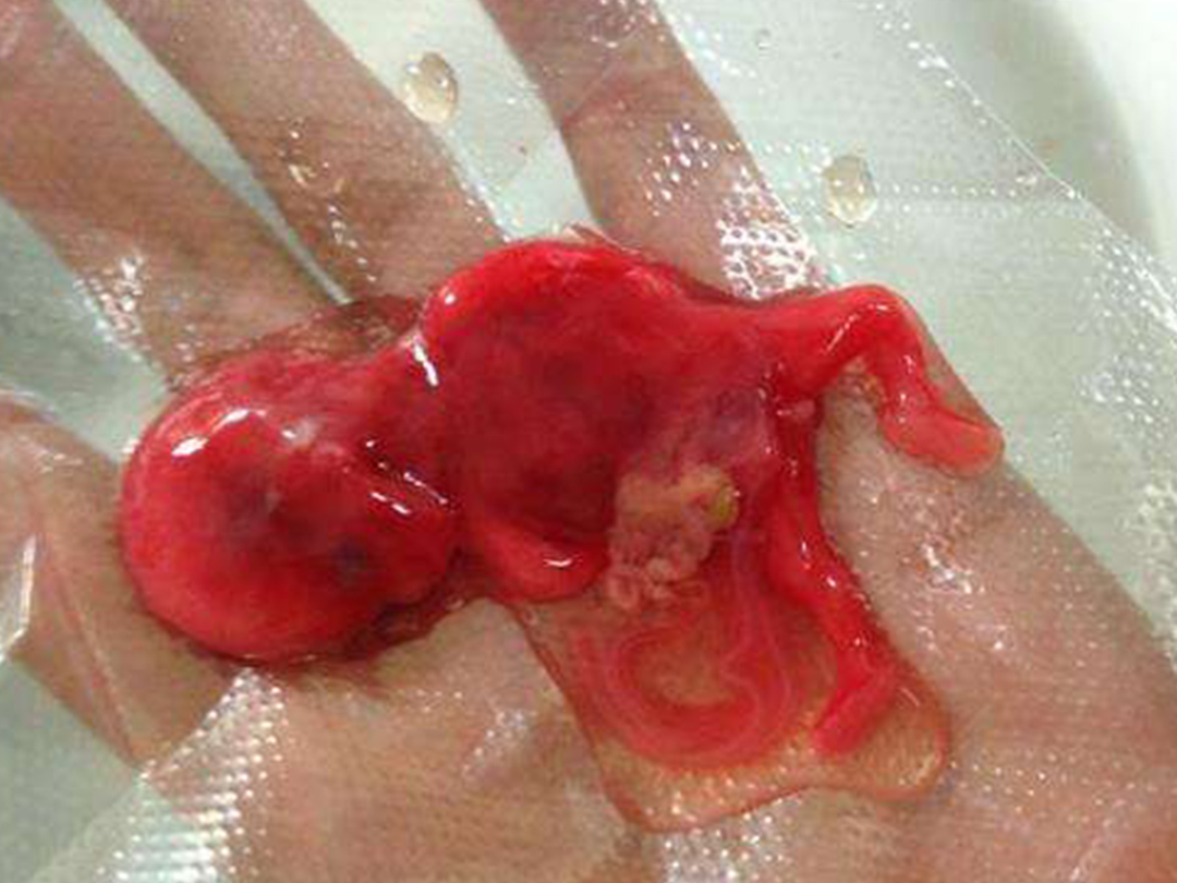 三个月胚胎流出来图片图片