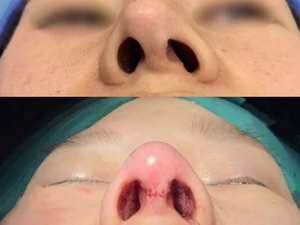歪鼻畸形