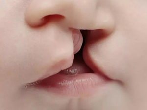 唇腭裂