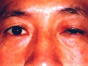 上胞下垂