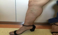 青筋腿